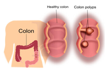 What are colon polyps?