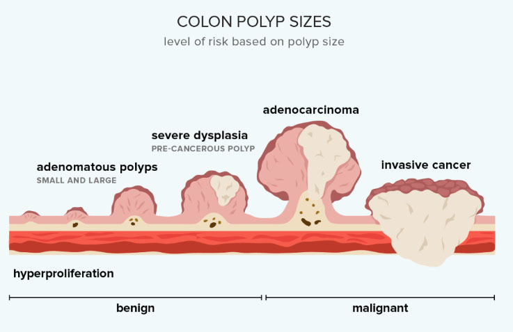 types of colon polyps dubai