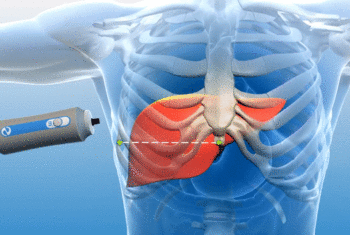 What is a Fibroscan