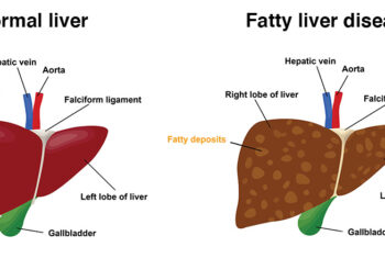 How is fatty liver detected