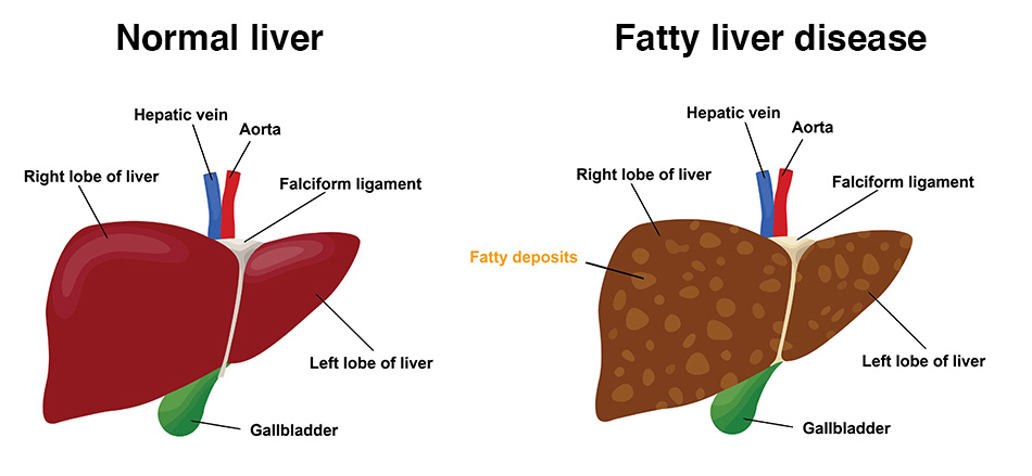 How is fatty liver detected