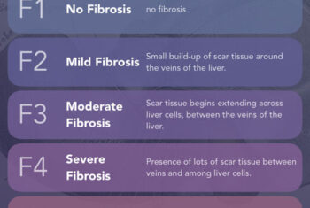 How does Fibroscan measure liver stiffness