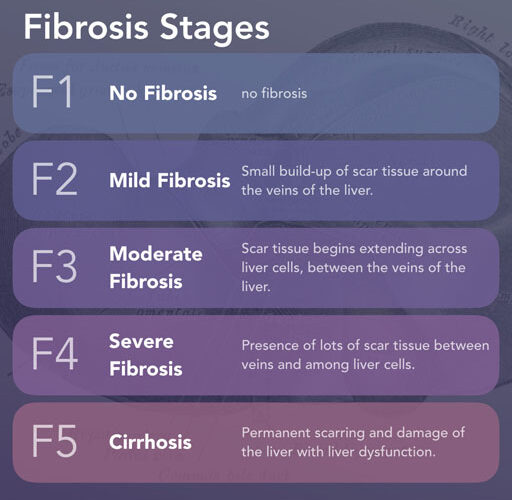 How does Fibroscan measure liver stiffness