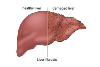 What is Liver fibrosis?