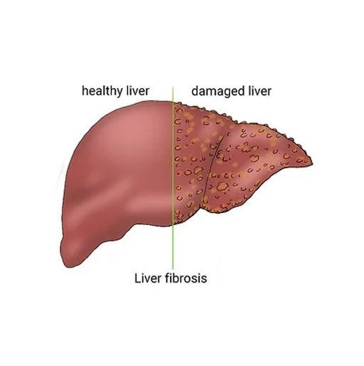 What is Liver fibrosis? - Dr Kaiser Raja